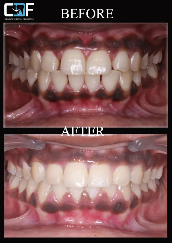 Dharshini Invisalign Intraoral